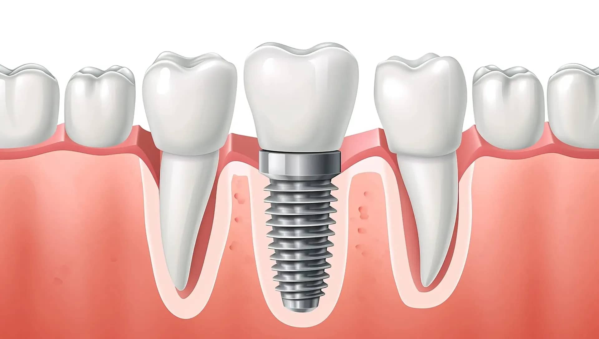 Dental implant systems