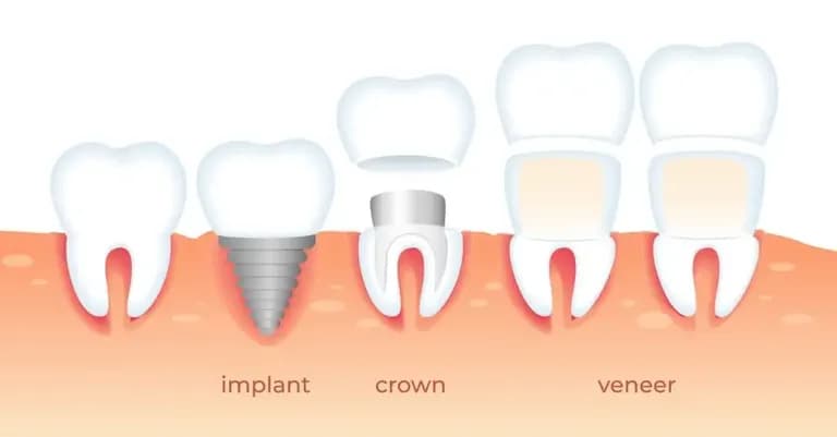 Implants or veneers