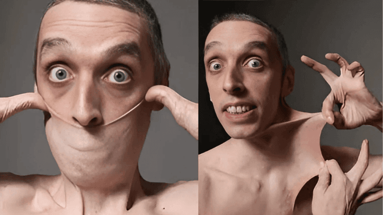 Garry Stretch Turner demonstrates his Guinness World Record for the world's stretchiest skin caused by Ehlers-Danlos syndrome
