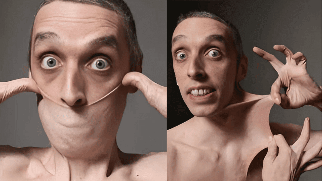 Garry Stretch Turner demonstrates his Guinness World Record for the world's stretchiest skin caused by Ehlers-Danlos syndrome