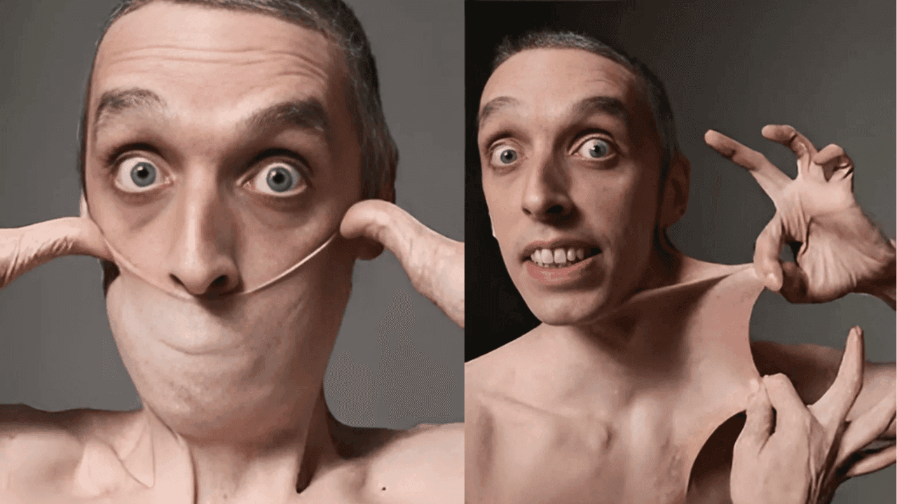 Garry Stretch Turner demonstrates his Guinness World Record for the world's stretchiest skin caused by Ehlers-Danlos syndrome