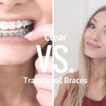Clear Aligners and Braces