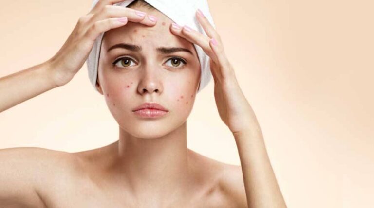 8 Things to Try If You Are Acne-Prone