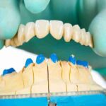 A Comprehensive Guide to Dental Porcelain Veneers