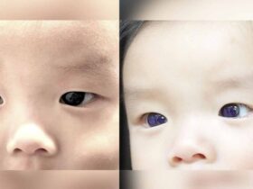 Baby's Eyes Turn Brown to Indigo Blue After COVID-19 Treatment, But why