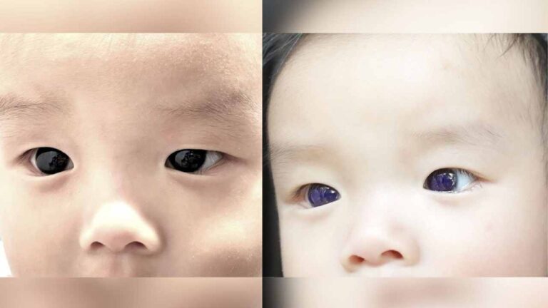 Baby’s Eyes Turn from Brown to Indigo Blue After COVID-19 Treatment, But why