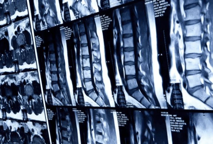 No More Paralyzing After Spine Injuries | Scientists Able to Regrow Spine Successfully