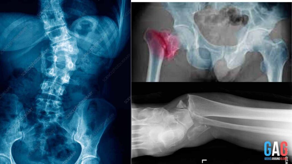X ray images of broken bones