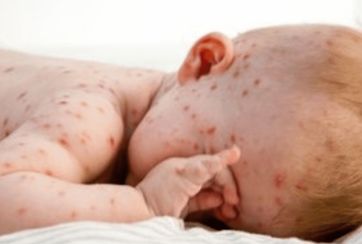 New York is going to screen all newborns for Incurable disease - Congenital Cytomegalovirus.