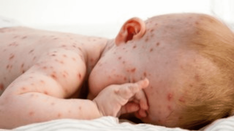 New York Started to Screen all Newborns for an Incurable Disease – Congenital Cytomegalovirus.