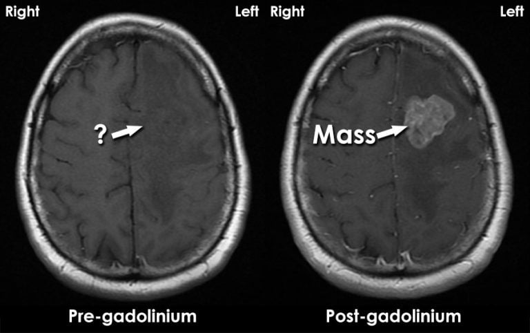 MRI contrast agents