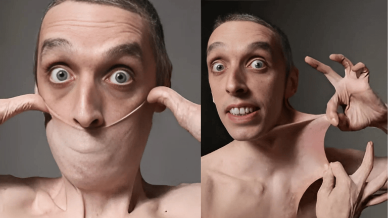 Garry Stretch Turner demonstrates his Guinness World Record for the world's stretchiest skin caused by Ehlers-Danlos syndrome
