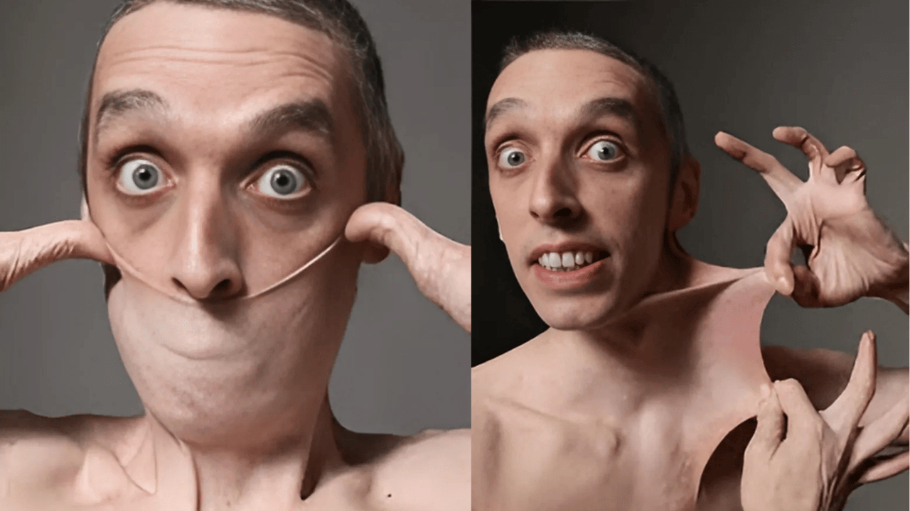 Garry Stretch Turner demonstrates his Guinness World Record for the world's stretchiest skin caused by Ehlers-Danlos syndrome