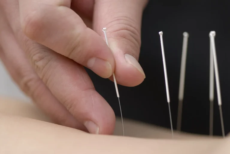 Acupuncture in Winnipeg